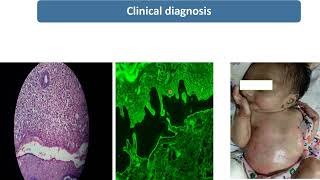 Epidermolysis Bullosa  Spot Diagnosis  9  Pediatrics [upl. by Proudfoot874]