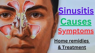 Sinusitis Infection  Symptoms Causes amp Treatment options [upl. by Wiener183]