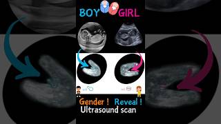 Baby boy baby girl on ultrasound baby shorts ultrasound [upl. by Sawyor]