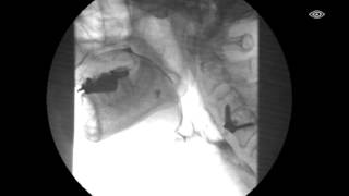 Modified Barium Swallow Test [upl. by Benjie]