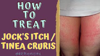 HOW TO TREAT JOCKS ITCH  TINEA CRURIS [upl. by Clyde]