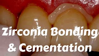 Zirconia Crown Cementation Bonding Protocols by Etching sandblasting amp Ivoclar Multilink [upl. by Aitnwahs]