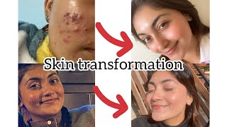 How I cleared my skin  transformed my acne prone dry skin in 2 months  My acne journey [upl. by Ajani364]