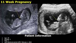 First Trimester Pregnancy Ultrasound Reporting  Obstetric USG Scan Reports  512 Weeks Fetal USG [upl. by Fraser]