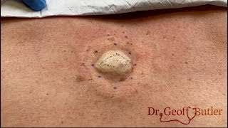 Removal of Epidermal Cyst on Back [upl. by Aihsekin]