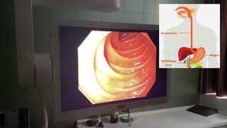 MediMittwoch 8 Magenspiegelung Gastroskopie [upl. by Trebbor]