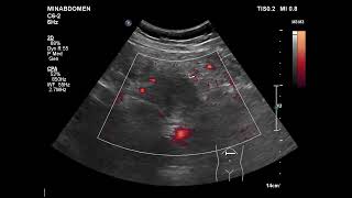 unmatching sono amp CT on pancreas [upl. by Juli841]