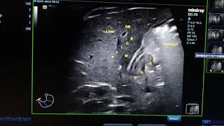 Hypertrophic Pyloric Stenosis HPS [upl. by Jakie108]