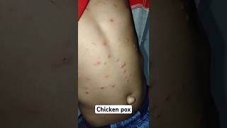 Chicken Pox  Typical picture of Chicken poxTreatment of 1 syp Calpol 2 calamine lotiondoctors [upl. by Melesa]