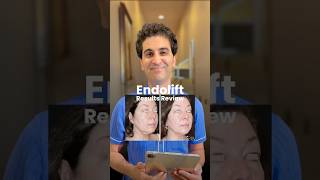 Stunning EndoLift Results Erase Jowls and Double Chin in Just Months [upl. by Jansen225]