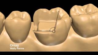 Posterior tooth preparations inlay onlay crownlay and crown [upl. by Omiseno]