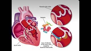 انتقال البكتيريا من السن الى القلب Infective endocarditis [upl. by Nyad]