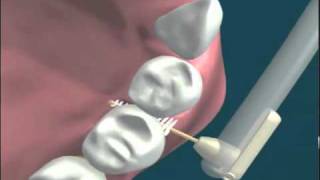 interdental brushing severe bone loss top view [upl. by Orran]