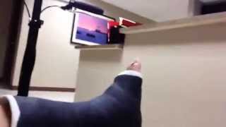 Ankle Fracture Vlog 1  Trimalleolar Fracture [upl. by Llib]