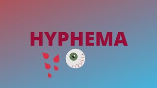 Hyphema  Definition Clinical FeaturesCauseComplicationTreatmentBlack ball 8  Ophthalmology [upl. by Nairod]