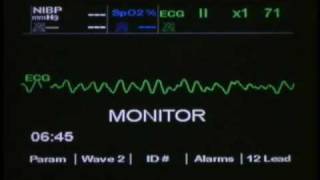 ventricular fibrillation [upl. by Akirahs]