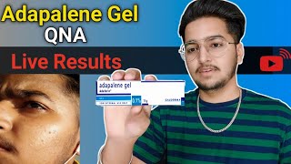 Adapalene Gel Results Showing  Adapalene Gel for Blackheads Whiteheads Treatment [upl. by Tonry]