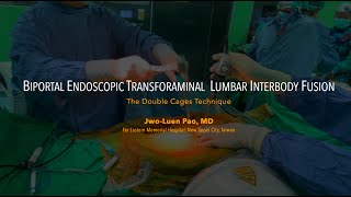 Paos Biportal Endoscopic Transforaminal Lumbar Interbody Fusion BETLIF using Double Cages [upl. by Hinkle]