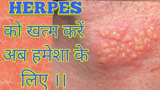 Herpes Treatment by the Simplest way by Asy Tips [upl. by Quennie551]