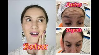 Botox I Antes e Depois I Vale a pena  Quanto custa [upl. by Siouxie]