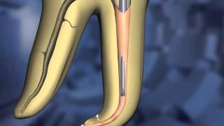 Continuous Wave technique  Dentsply Sirona [upl. by Ahsirkal435]