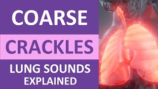 Coarse Crackles Lung Sounds Audio Causes Auscultation Nursing NCLEX Review [upl. by Reinald390]