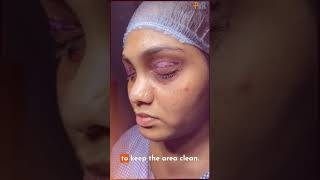 Brighten Up Your Eyes Eye Bag Removal Surgery  PostSurgery Care Tips Included [upl. by Fransis]