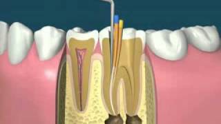 traitement endodontiquedevitalisationflv [upl. by Aiyot]