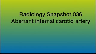 Aberrant internal carotid artery [upl. by Ys463]