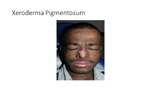 Xeroderma Pigmentosum [upl. by Napra]