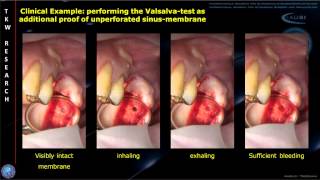 INTRALIFT Histology Study JOMS Audioslides [upl. by Abdulla]