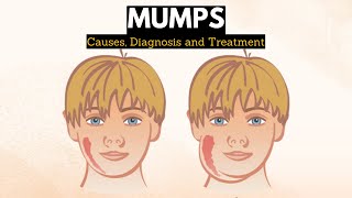 Mumps Causes Signs and Symptoms Diagnosis and Treatment [upl. by Trik403]