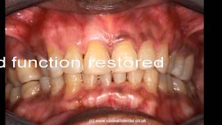 Generalised advanced teeth wear TSL restoration by Vaswani Dental at Southgate London N14 [upl. by Matthews]