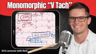 Monomorphic Ventricular Tachycardia VT EKG  ECG Lecture [upl. by Claiborne]