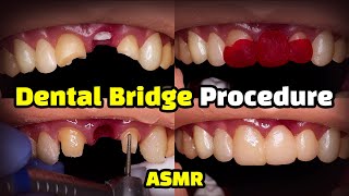 Dental Bridge Procedure [upl. by Llehsad]