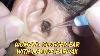 Womans Clogged Ear with Massive Earwax is Finally Removed [upl. by Ellenyl]