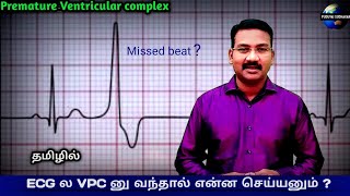 Ventricular Ectopic tamil  Ventricular Premature complex  Premature beat ECG Arrhythmias tamil [upl. by Nirak467]