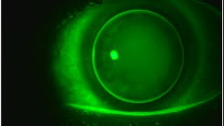 Multifocal GP Contact Lenses Video 3 [upl. by Ayet76]