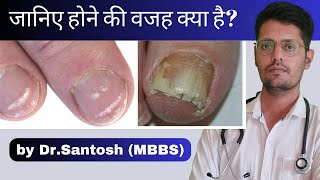 Causes of white spots in finger amp toe nails in hindi Leukonychia causes causes of abnormal nails [upl. by Stacy262]