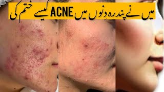 Acne treatment how to get rid of from acne how to remove acne pimples treatment reason of acne [upl. by Aratas999]