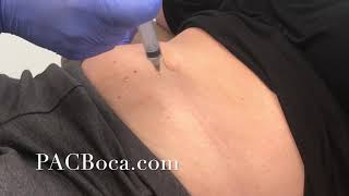 Lipolysis Injections Dr Sharabi PACBocacom [upl. by Cira]