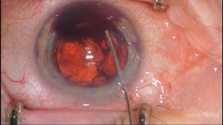 Safe and Simple Hyphema Removal [upl. by Reave]