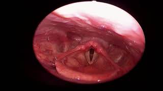 Jalaj Srivastav Fiberoptic examination of larynx 18 01 24 [upl. by Sura849]