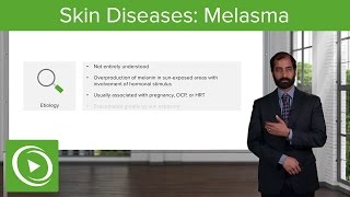 Skin Diseases Melasma Chloasma – Pathology  Lecturio [upl. by Otsuj]