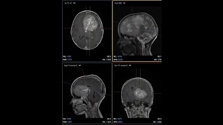 Huge supratentorial brain lesion in a 9 year old boy [upl. by Paapanen784]