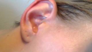 ear  hydrogen peroxide [upl. by Leirbag]