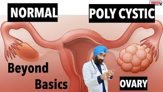 Polycystic Ovary  PCOD  PCOS  Explained Beyond Basics  DrEducation [upl. by Airdnna223]