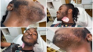 MALE CHIN WAX  INGROWN HAIR REMOVAL  Muva K Aesthetics [upl. by Lamberto]