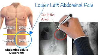 Pain in lower left abdomen  Low Stomach Pain Most Common Causes [upl. by Sateia]