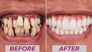 Transform Your Smile How We Prepare a Right Frontal Incisor Crown [upl. by Ellenor]